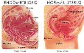 endometriosis mujer