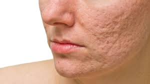 remedios para eliminar manchas de acné